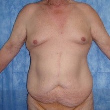 Paciente masculino, ANTES de Cirugía Contorno inferior: Abdomen