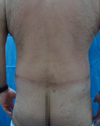 Paciente masculino, DESPUÉS de Cirugía Circunferencial