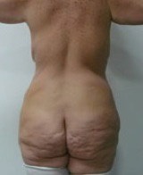 Paciente femenino, ANTES de Cirugía contorno corporal inferior: Glúteos