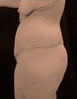 Paciente femenino, DESPUÉS de Cirugía contorno corporal inferior: Glúteos lateral