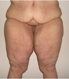 Paciente femenino, ANTES de Cirugía contorno corporal inferior: Muslos