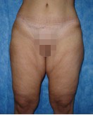 Paciente femenino, DESPUÉS de Cirugía contorno corporal inferior: Muslos